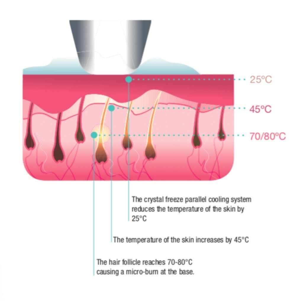 Elysion-PRO diódalézeres tartós szőrtelenítés